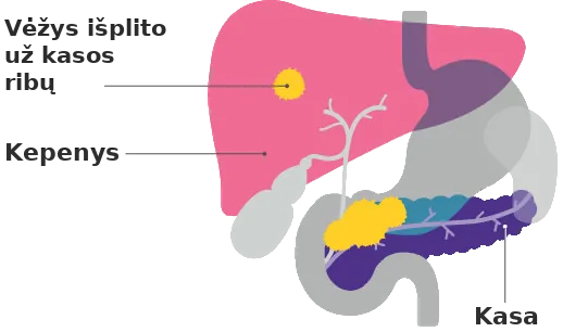 Pancreatic cancer stage 4